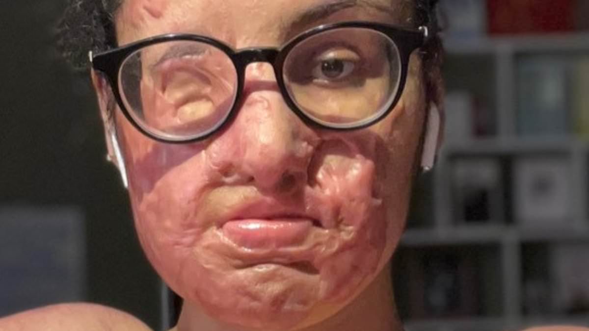 Brooklyn Man Indicted in 5-Year-Old Acid Attack Case That Reignited Justice Delay Debates