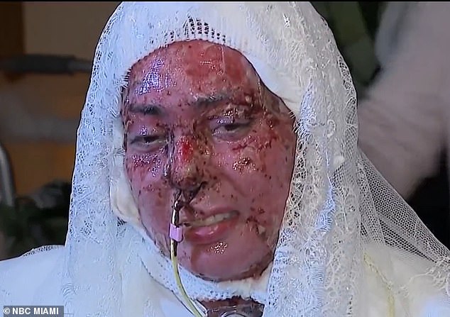 Devastating Grill Explosion Leaves Arianna Esquiline with Severe Burns and an Unexpected Life Decision