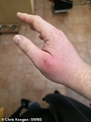 From Minor Bite to Amputation: Man's Devastating Fight Against a Rare Spider Bite