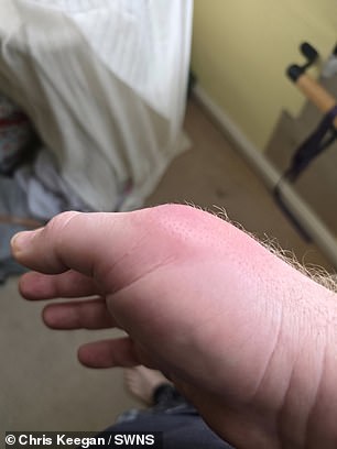 From Minor Bite to Amputation: Man's Devastating Fight Against a Rare Spider Bite