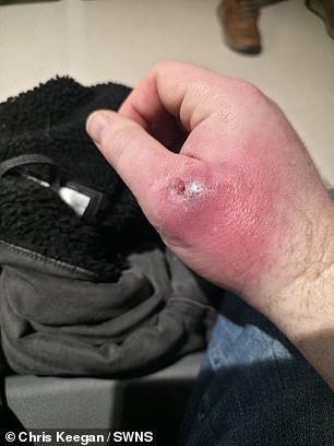 From Minor Bite to Amputation: Man's Devastating Fight Against a Rare Spider Bite