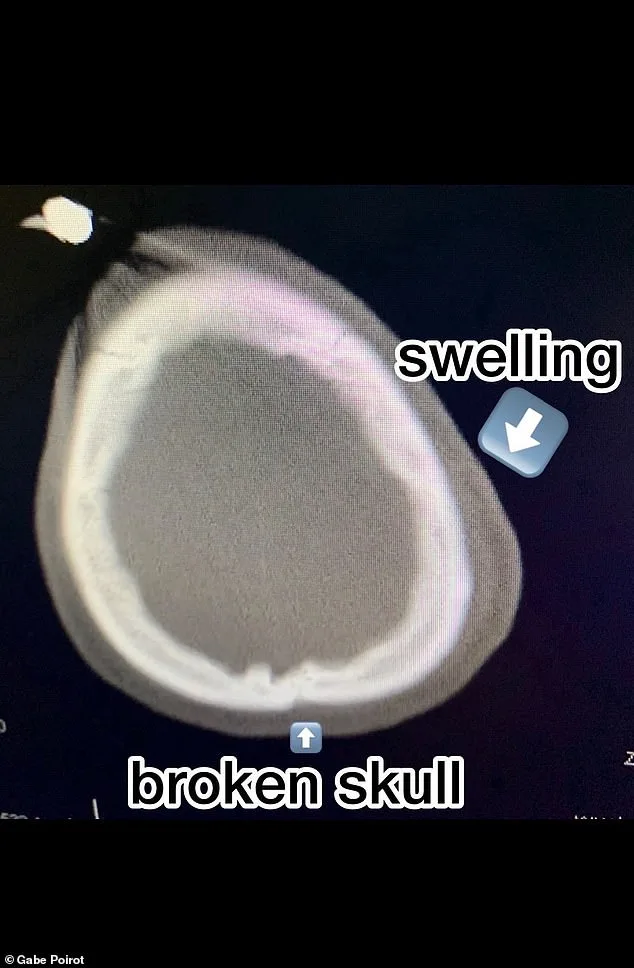 Miraculous Survival: Gabe Poirot Defies Death After Devastating Skateboard Accident