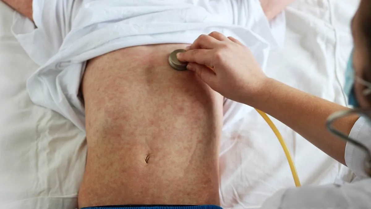 Measles Outbreak: US at Risk of Losing Elimination Status