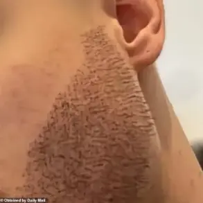 Botched Hair Transplants and the Crisis of 'Conveyor Belt' Clinics in Medical Tourism